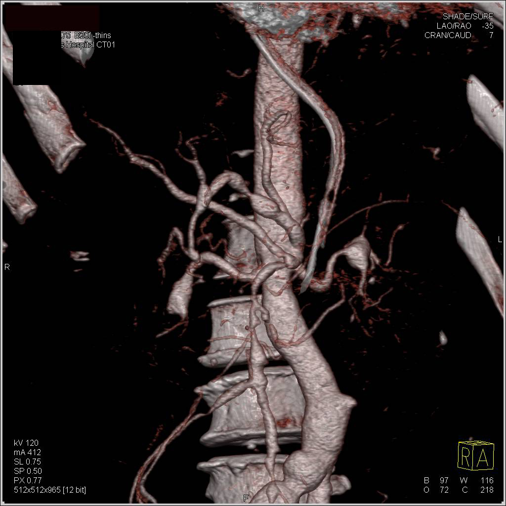 Ehlers-Danlos with Mesenteric Artery Aneurysms - CTisus CT Scan