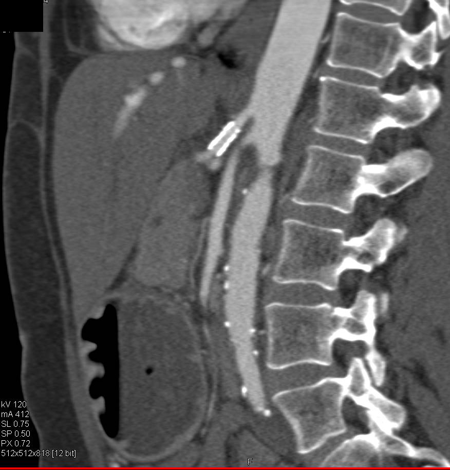 Patent Stent in Celiac Axis - Vascular Case Studies - CTisus CT Scanning