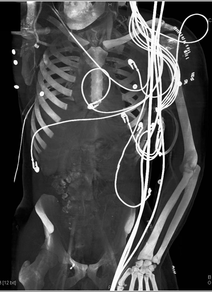 Patent Stent in the Left Axillary Artery - CTisus CT Scan