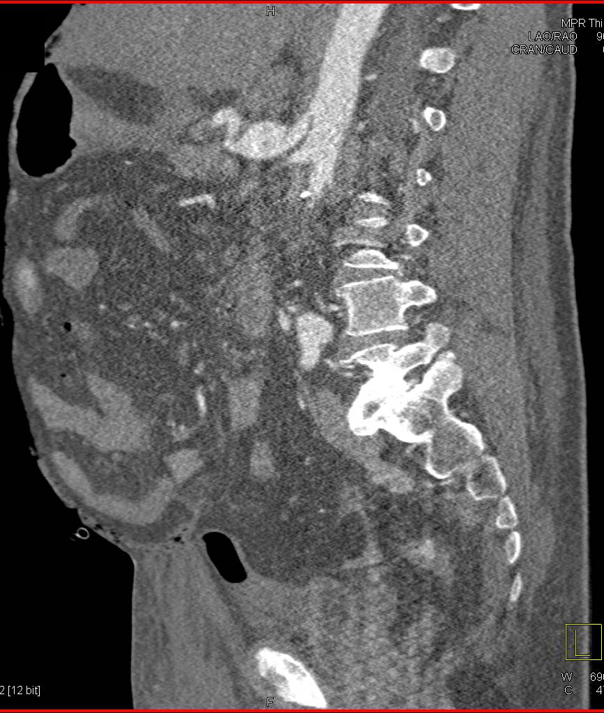 Multiple Mesenteric Artery Aneurysms Including the Hepatic Artery - CTisus CT Scan