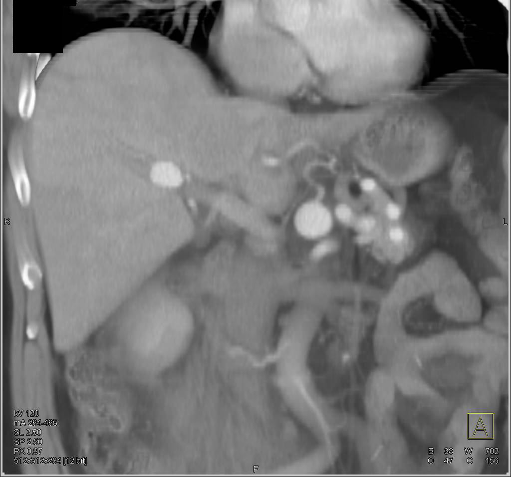 Hepatic Artery Aneurysm - CTisus CT Scan