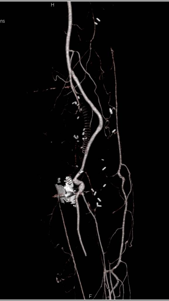 CTA of Failed Vascular Bypass Graft in Thigh - CTisus CT Scan