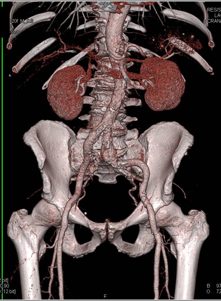 CTA Runoff with Peripheral Vascular Disease and Artifact off Total Knee Replacement - CTisus CT Scan