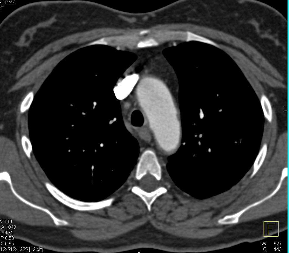 Focal Ulceration Lower Thoracic Aorta - CTisus CT Scan