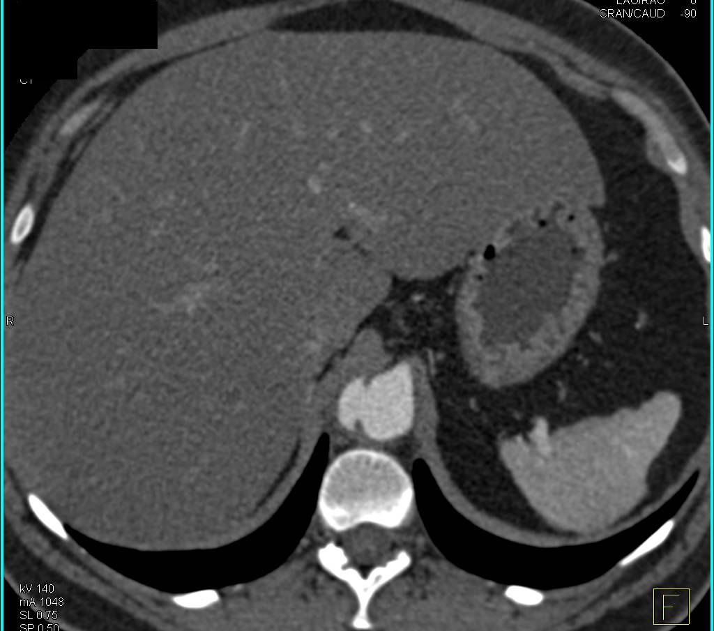 Focal Dissection Descending Thoracic Aorta - CTisus CT Scan