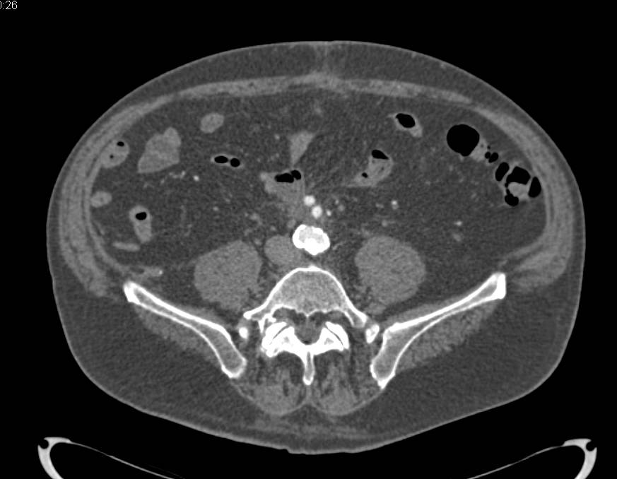 Dilated IMA in Patient with Celiac Stenosis in Addition to Extensive Vascular Disease Involving the Aorta - CTisus CT Scan