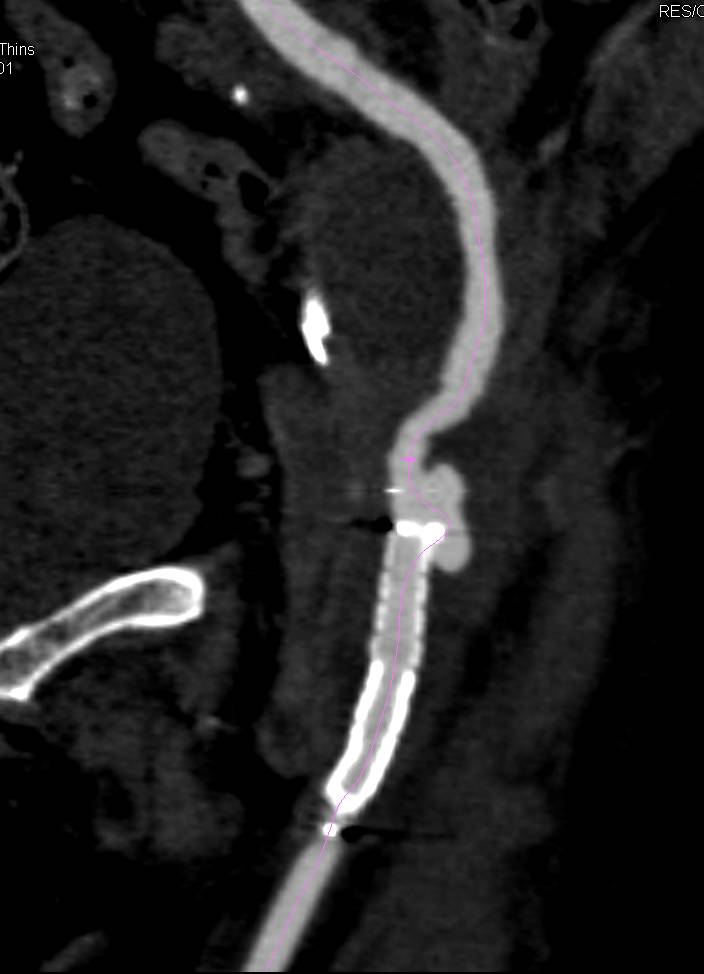 Patent Left Superficial Femoral Artery (SFA) to Popliteal Artery Graft with Pseudoaneurysm Near Stent Graft in Thigh - CTisus CT Scan