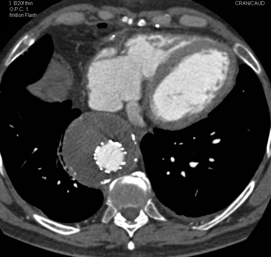 Endovascular Stent Placement in the Thoracic Aorta - CTisus CT Scan