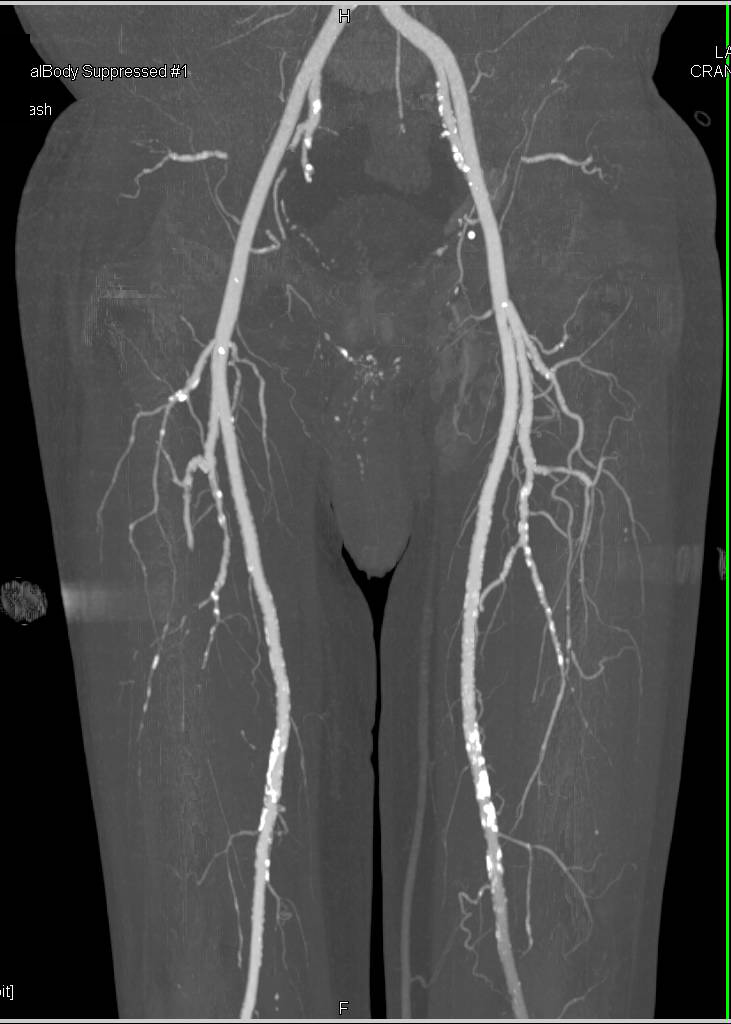 CTA Runoff with Peripheral Vascular Disease in Trifurcation Vessels - CTisus CT Scan