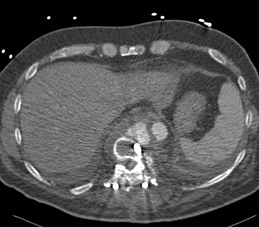 Amazing Case Where Spinal Rod Erodes Aorta and Create a Pseudoaneurysm - CTisus CT Scan