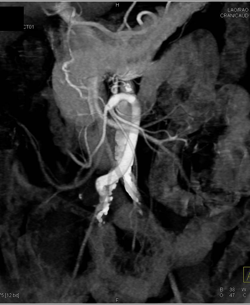 Graft Placed to Right Iliac Artery to Mesenteric Arcade - CTisus CT Scan