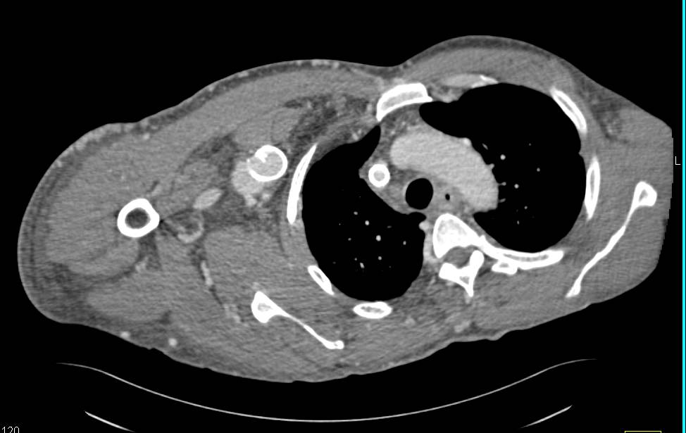 Arteriovenous (AV) Shunt Arm with Stent in Right Axiillary Vein Which is Compressed in Patient with Impressive Collaterals - CTisus CT Scan