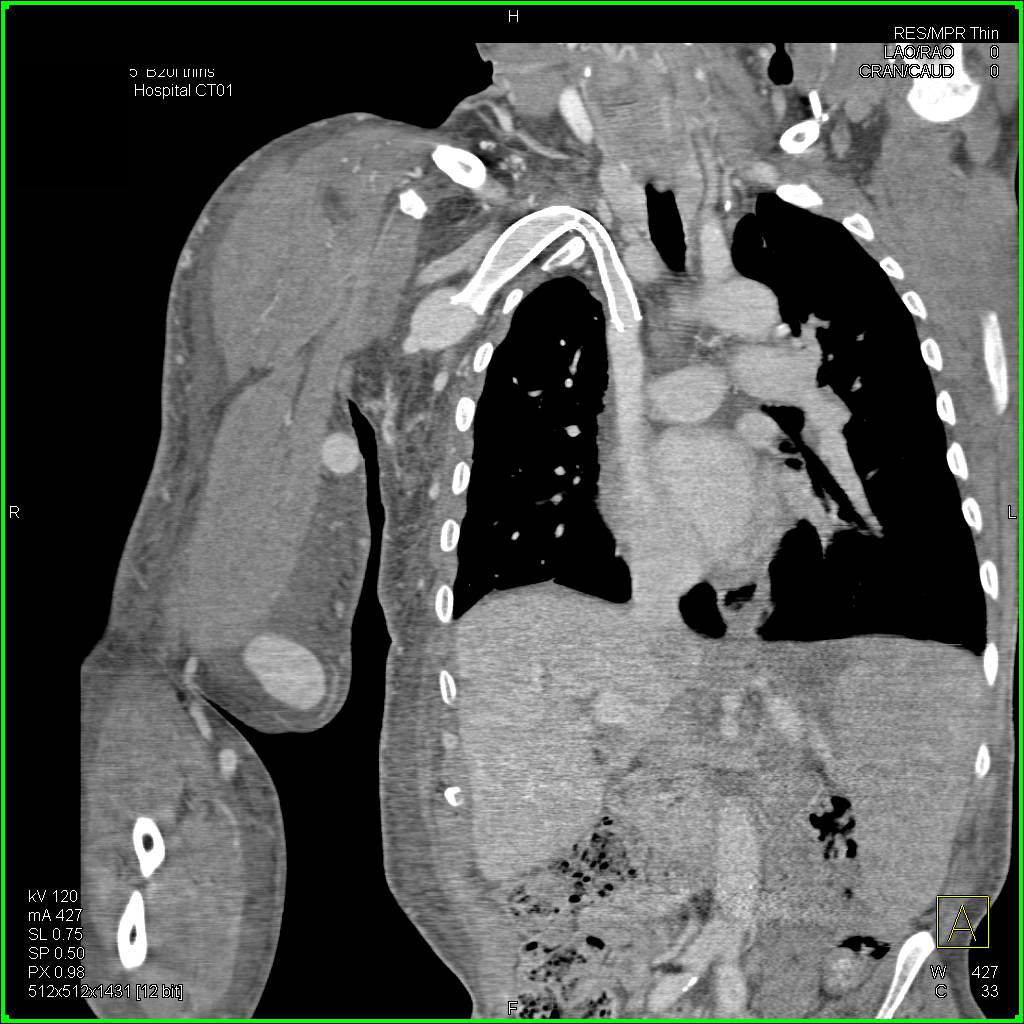 Stent in Right Axillary Vein that is Compressed in Patient with an Arteriovenous (AV) Fistulae - CTisus CT Scan