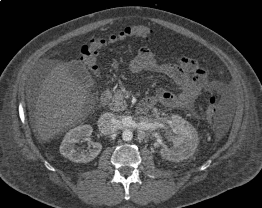 Renal Cell Carcinoma Invades the Left Renal Vein, Inferior Vena Cava (IVC) and Extends Into the Right Atrium - CTisus CT Scan