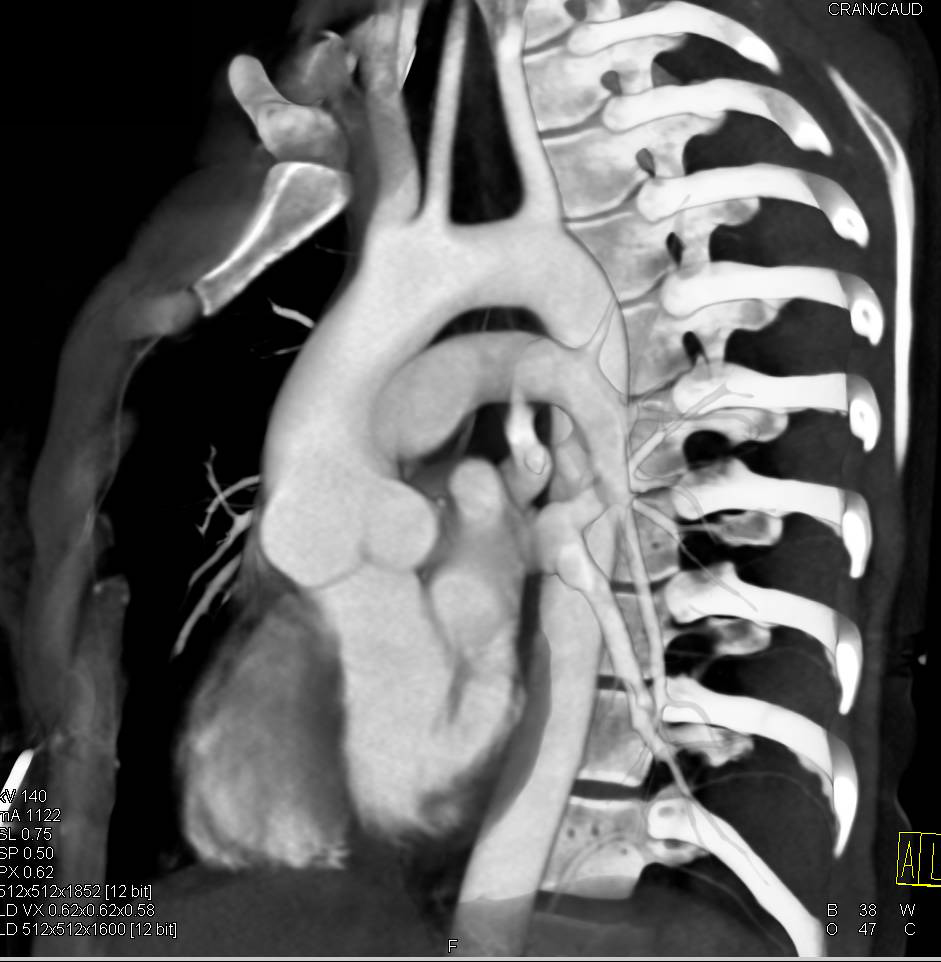 dilated aortic arch