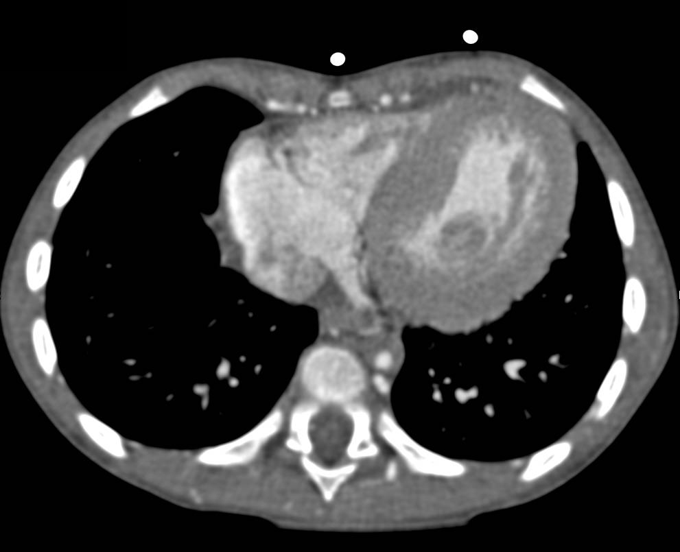 Interrupted Descending Thoracic Aorta with Collaterals - CTisus CT Scan
