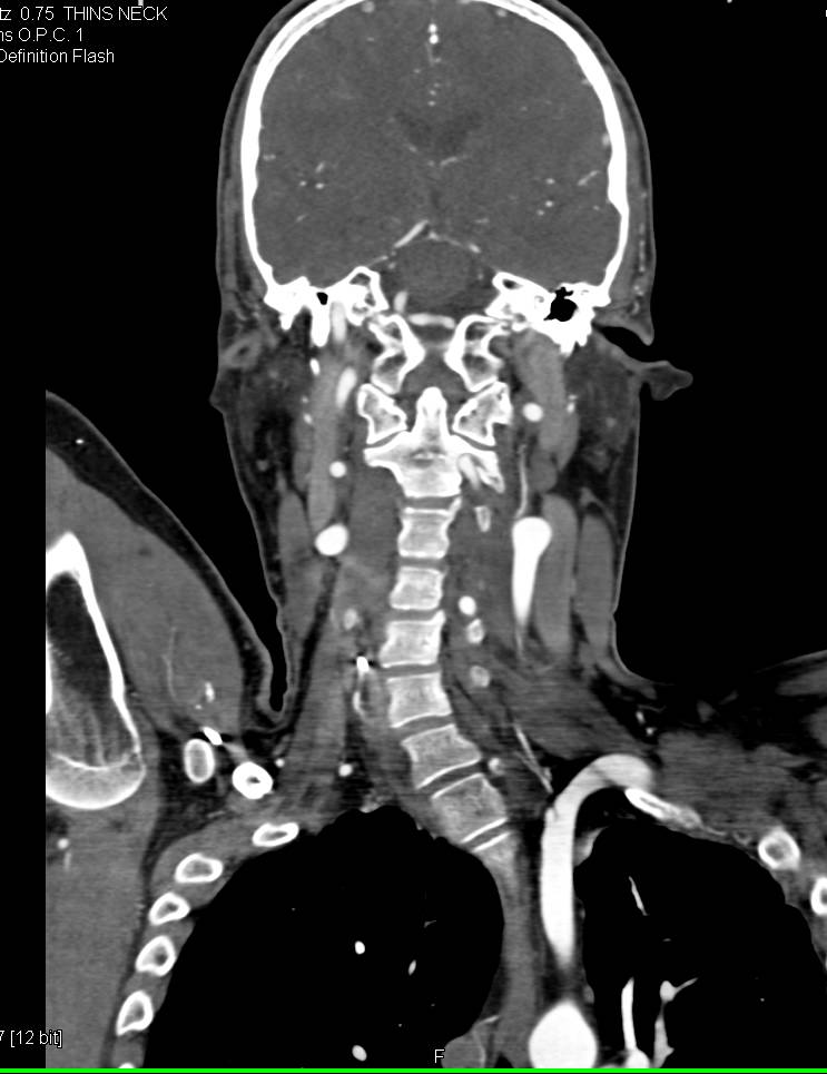 Focal Dissection of the Left Subclavian Artery in Loeys-Dietz Syndrome - CTisus CT Scan