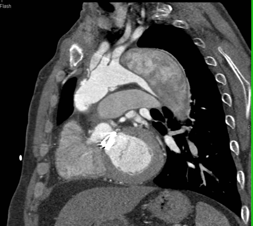 Type B Dissection - CTisus CT Scan