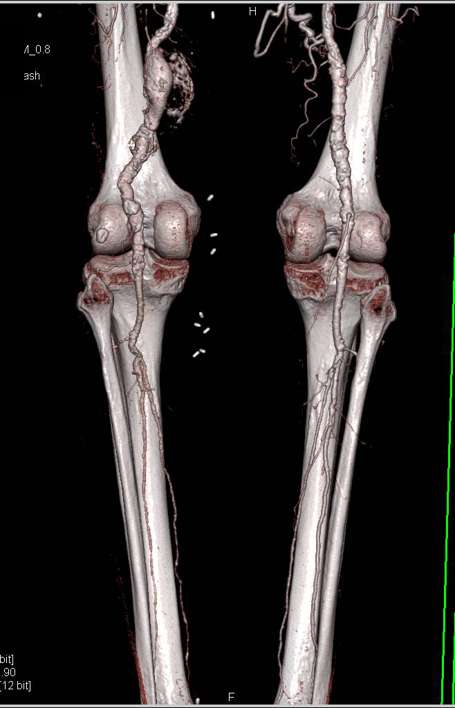 Extensive Vascular Disease with Strictures and Aneurysms - CTisus CT Scan