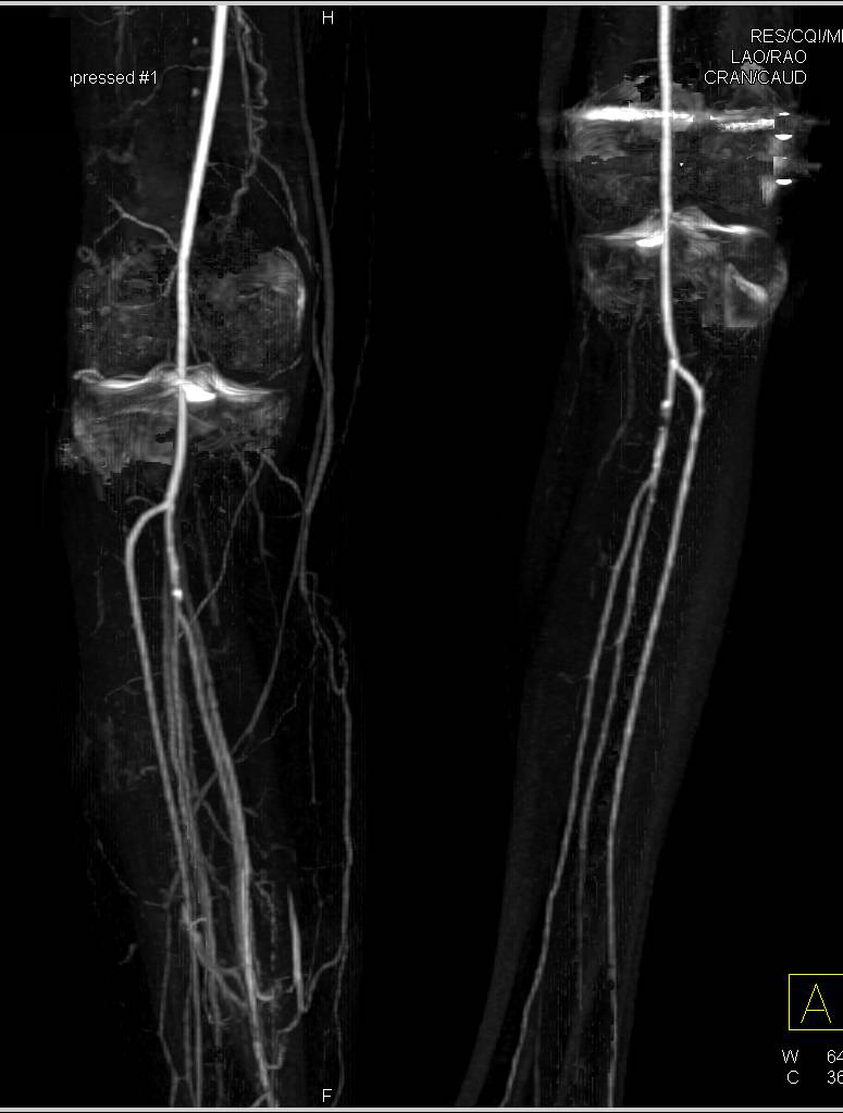 CTA Runoff Shows Dual Energy Bone Removal is Better for Run-off Vascular Mapping - CTisus CT Scan