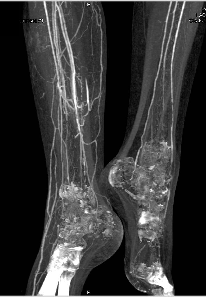 CTA Runoff with Extensive Hardware but Good Visualization - CTisus CT Scan