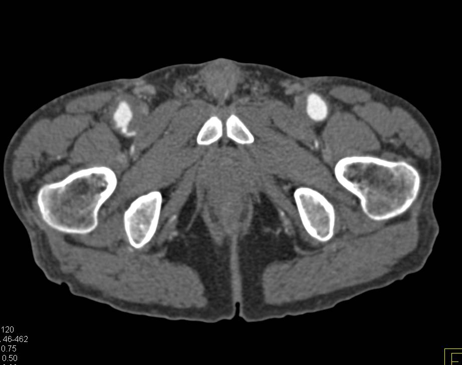 Pseudoaneurysms Both Superficial Femoral Arteries (SFAs) Near Anastomotic Sites for Fem-Fem Bypass - CTisus CT Scan