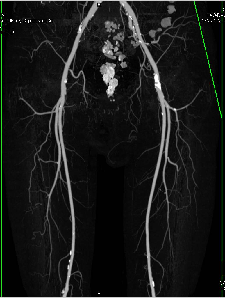 CTA Runoff with Minimal Peripheral Vascular Disease (PVD) - CTisus CT Scan