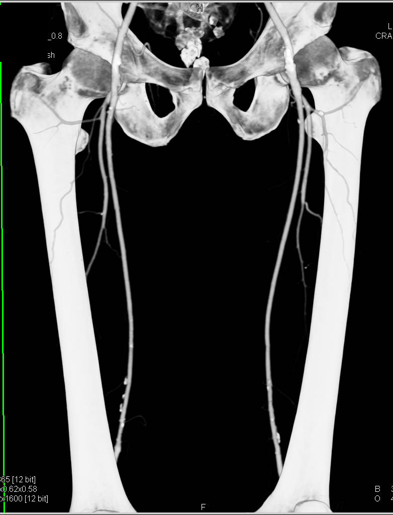 Runoff with Minimal Plaque - CTisus CT Scan