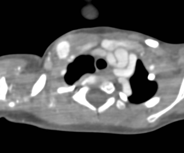 Ectatic Carotid Arteries in Loeys-Dietz Syndrome - CTisus CT Scan