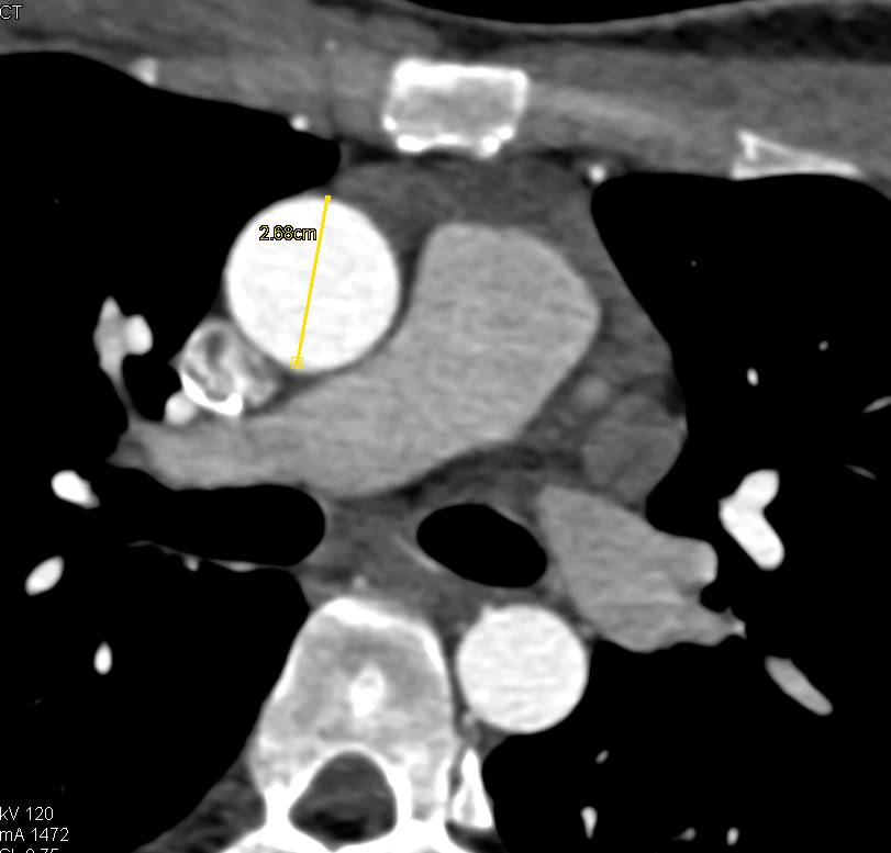 Dilated Sinus of Valsalva When the Correct Measurement is Made - CTisus CT Scan