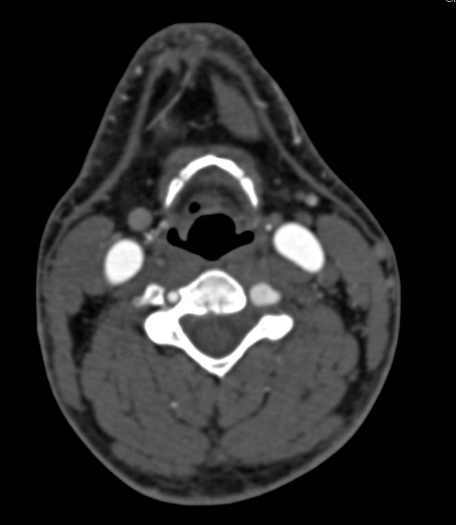 Multiple Aneurysms in Vertebral, Iliac and Superior Mesenteric Artery (SMA) Arteries - CTisus CT Scan