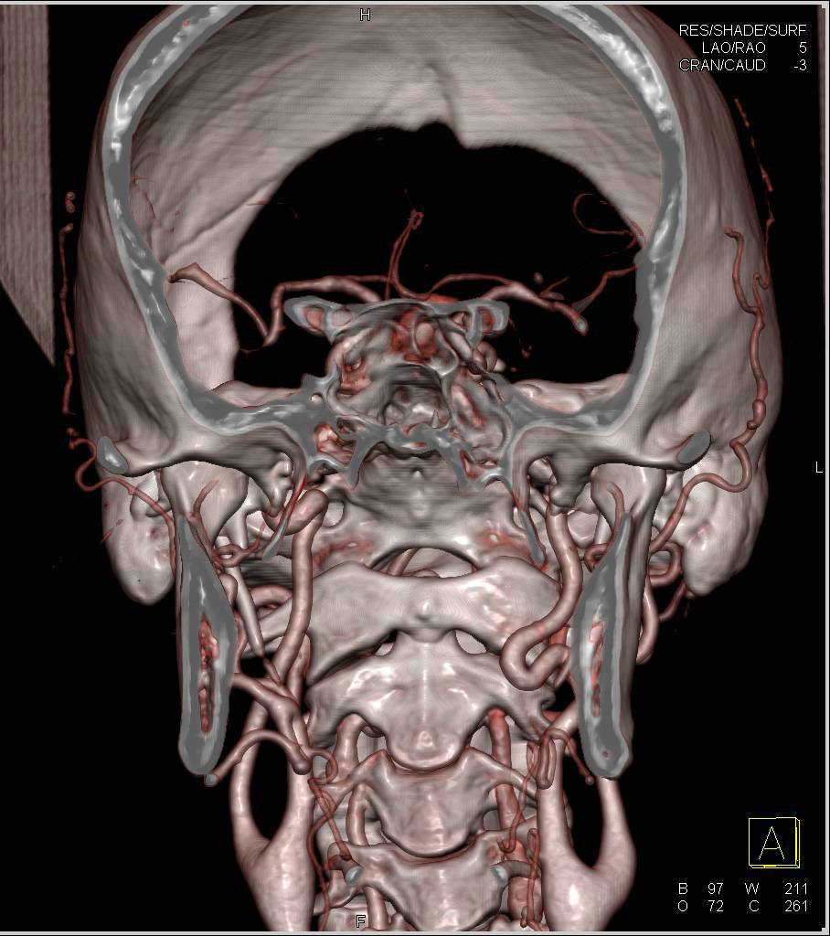 Ectatic Carotid Arteries in Loeys-Dietz Syndrome - CTisus CT Scan