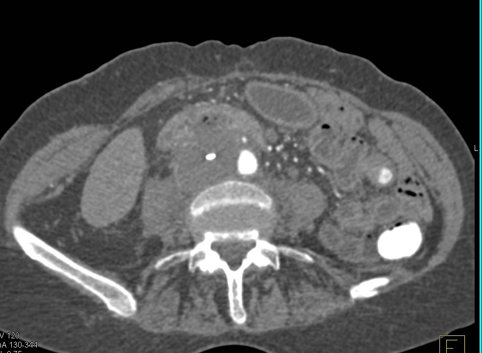 Aorto-Enteric Fistulae - CTisus CT Scan