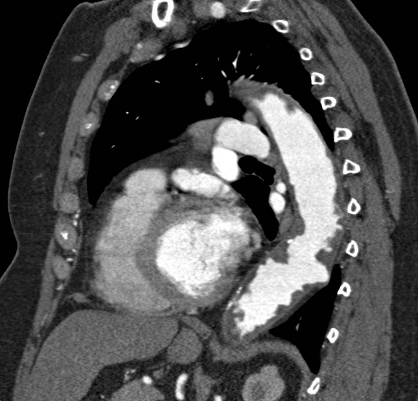 Multiple Ulcerations Descending Thoracic Aorta - CTisus CT Scan