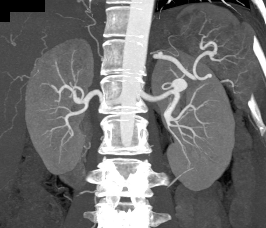 Left Renal Artery Aneurysm - CTisus CT Scan