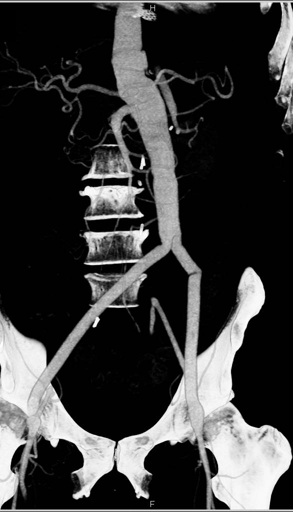 Aortic Aneurysm Repair with Grafts - CTisus CT Scan