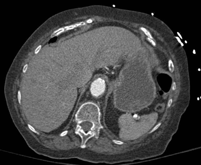 Aortic Aneurysm with Aorto-Enteric Fistulae - CTisus CT Scan