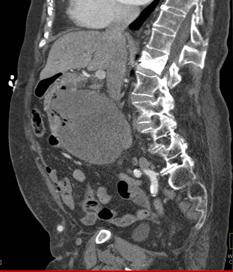 Aorto-Enteric Fistulae - CTisus CT Scan