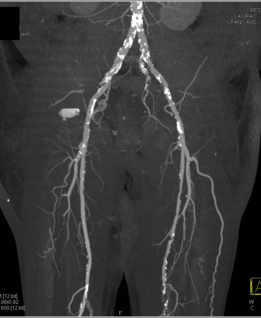 Patent Stent in Left Subclavian Artery as well as Diseased Superficial Femoral Arteries (SFAs) Especially on the Left - CTisus CT Scan