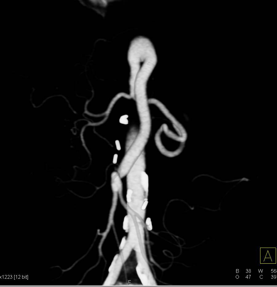 Vascular Surgery with Reimplanted Superior Mesenteric Artery (SMA) and Graft to Celiac Artery - CTisus CT Scan