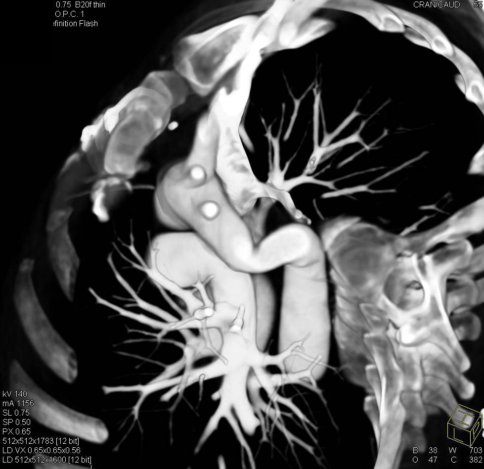 Prior Repair of a Coarctation of the Aorta - CTisus CT Scan