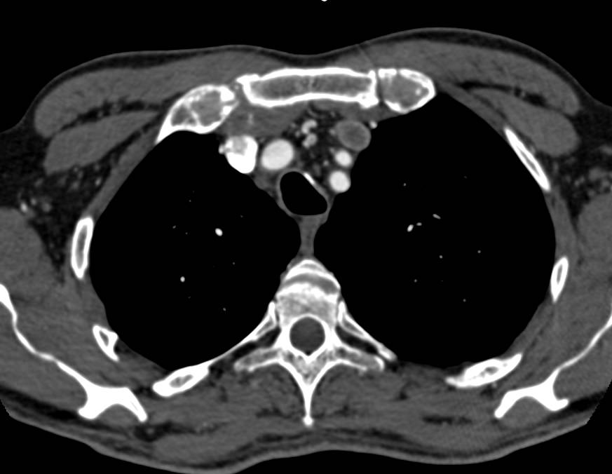 Vascular Disease with Grafts to Both Kidneys (renal arteries) - CTisus CT Scan