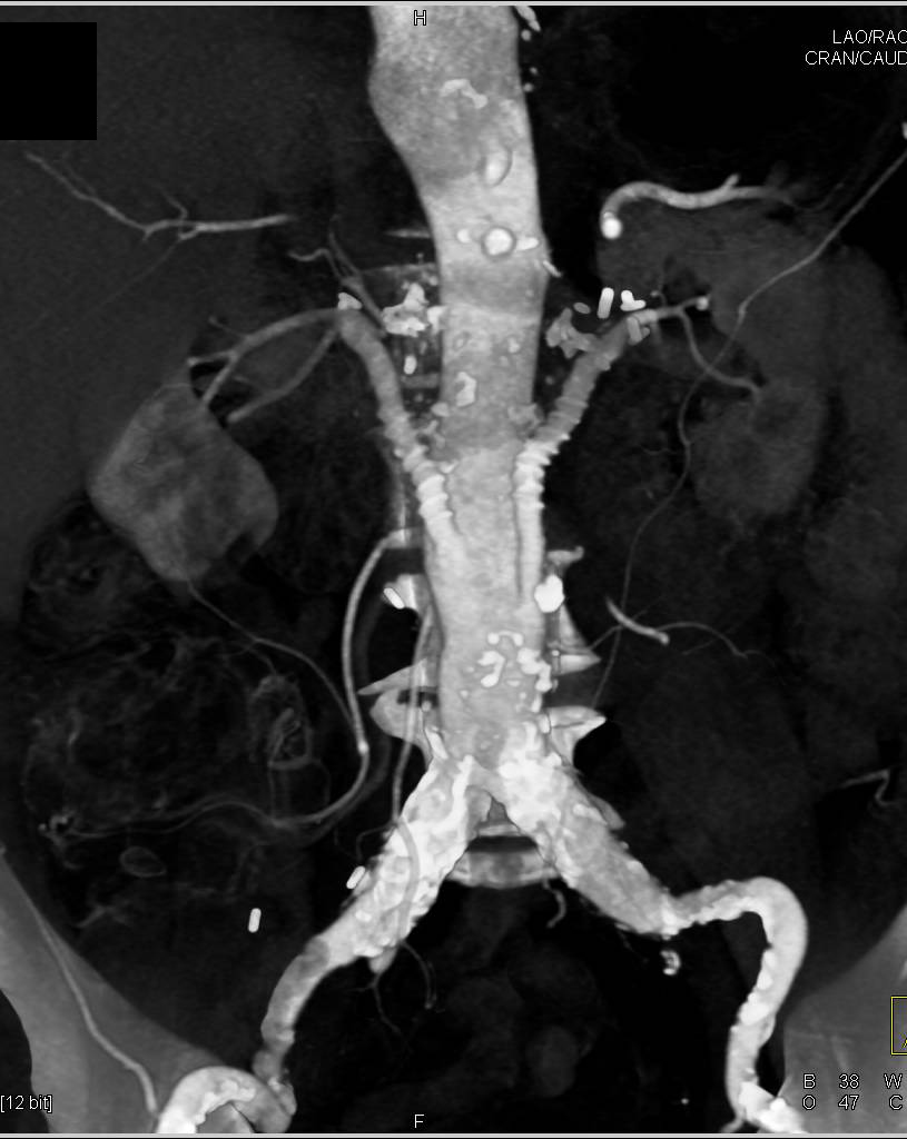 3D Mapping of Reimplanted Renal Arteries - CTisus CT Scan