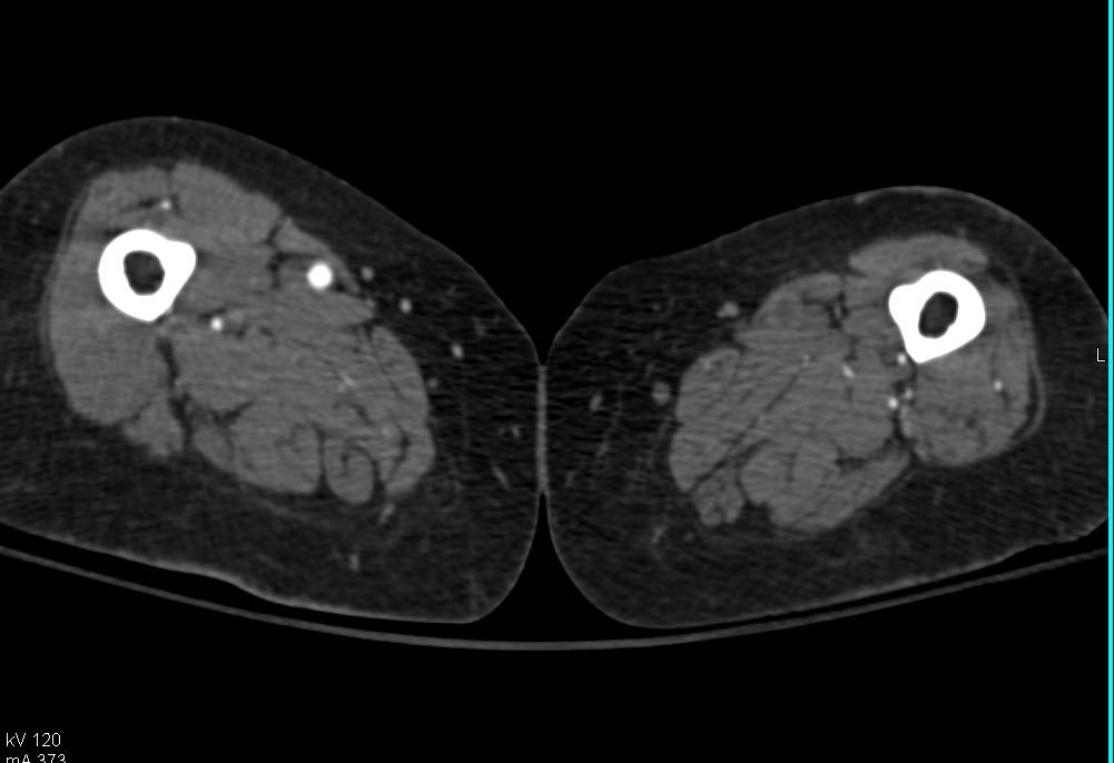 CTA with Occlusion of Left Superficial Femoral Artery (SFA) - CTisus CT Scan