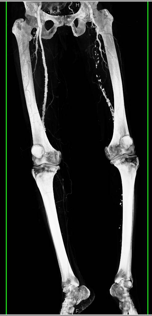 Occluded Left Superficial Femoral Artery (SFA) - CTisus CT Scan