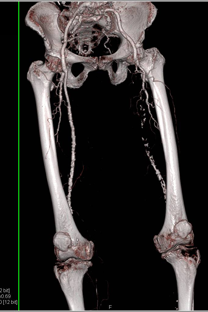 Occluded Left Superficial Femoral Artery Sfa Vascular Case Studies