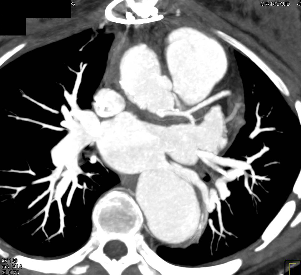 Type B Dissection and Celiac and Superior Mesenteric Artery (SMA) Arise From True Lumen in 3D VRT - CTisus CT Scan