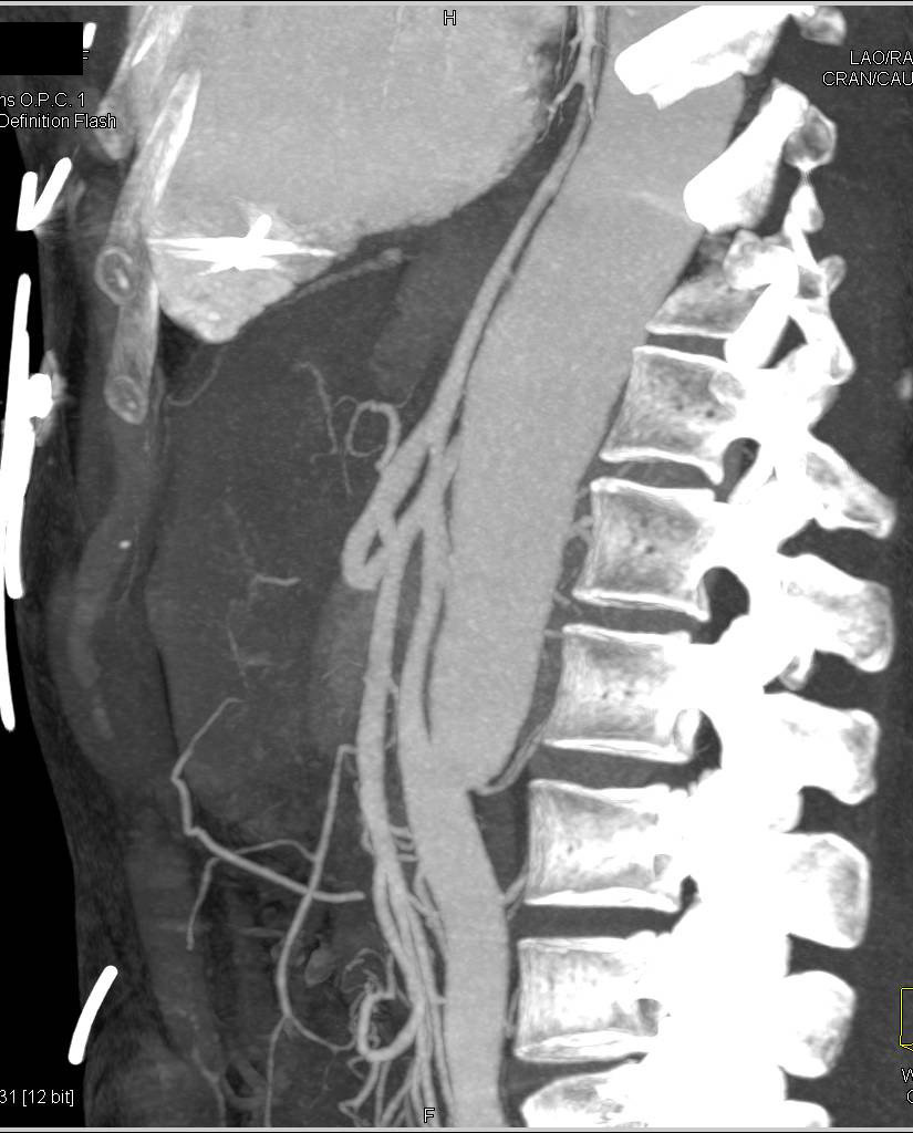 Type B Dissection - CTisus CT Scan