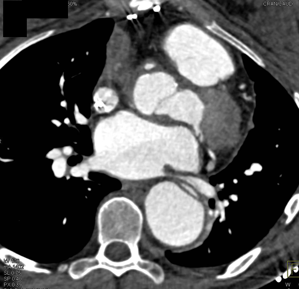 Marfan Syndrome with Type B Dissection - CTisus CT Scan