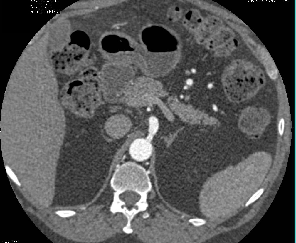 Ehlers-Danlos Vascular Type with Iliac Grafts That Become Narrowed - CTisus CT Scan